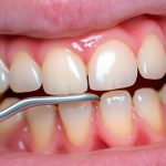 Arthritis & Rheumatology |10分文章帶你揭秘微生物組學(xué)研究口腔微生物與類(lèi)風(fēng)濕關(guān)節炎之間的聯(lián)系