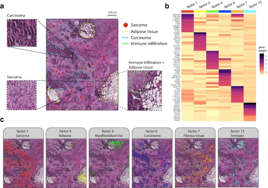 FFPE空間轉錄組解析卵巢癌肉瘤免疫浸潤過(guò)程[4]
