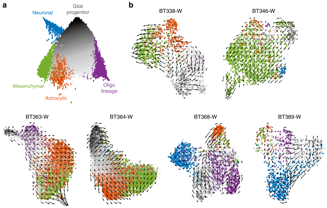 圖2?基于RNA?velocity分析膠質(zhì)母細胞瘤細胞分化路徑[4]