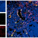 《cell reports》慢性肉芽腫病的發(fā)病機制新發(fā)現